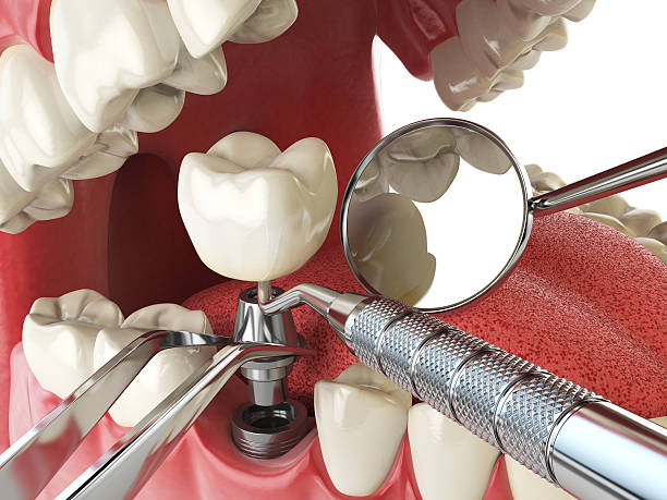 Best Broken or Cracked Tooth Emergency Dentist in Norris City, IL